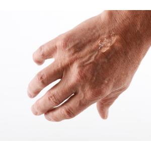 KRUUSE HydroGel w. Polyhexanide 0.04%, sterile, 15 g x 10/pk KRUUSE HydroGel w. Polyhexanide 0.04%, sterile, 15 g x 10/pk