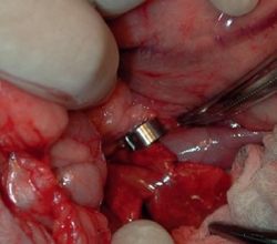 Ameroid Constrictor 6.0 mm Sterile [AC60-A]