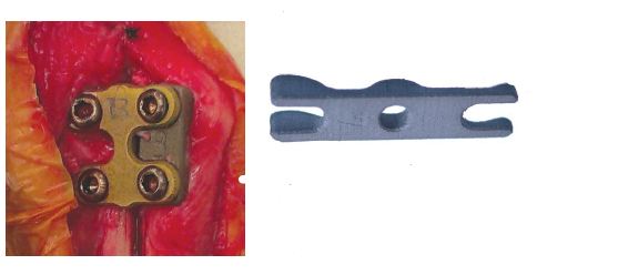 TTA RAPID PATELLAR LUXATION SPACER 2 Holes 2mm Height, Right [TTAR132802002R]