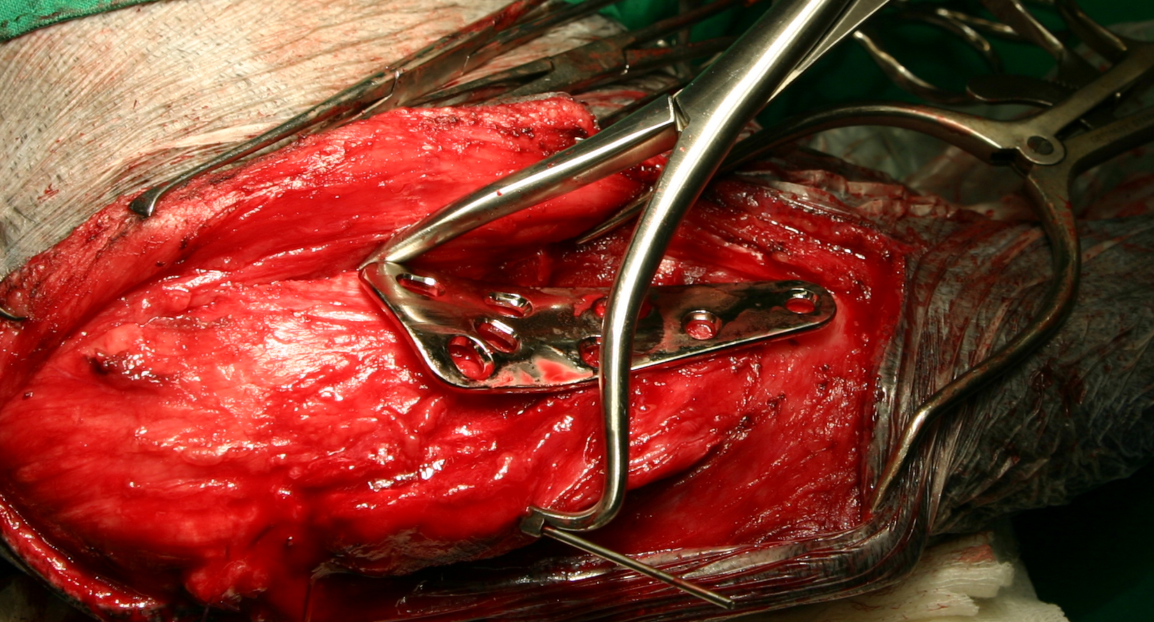 TPLO REDUCTION FORCEPS WITH WIRE GUIDE - LEFT [TPLORFL]